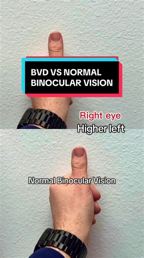 Understanding Binocular Vision Dysfunction Tests
