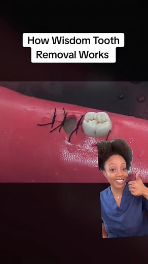 Wisdom Teeth Removal Process: Step-by-Step Guide