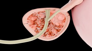 Prostate cancer stages. ancerous cells, malignant tumor compresses urethra. Pathological disruption, genital reproductive system anatomy, bladder Oncological or Urological Disease, bph, 3d render