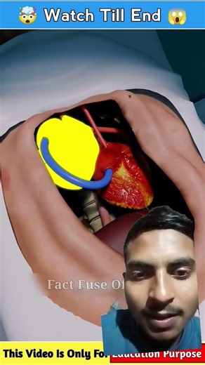 Man Survives Two Heart Attacks #facts #shortsfeed #shorts #factsinhindi #3danimation #short