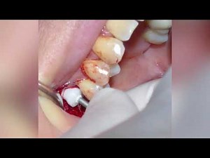 Z-systems tissue level implant and crestal sinus lift with PRF by Dr Sarkissian