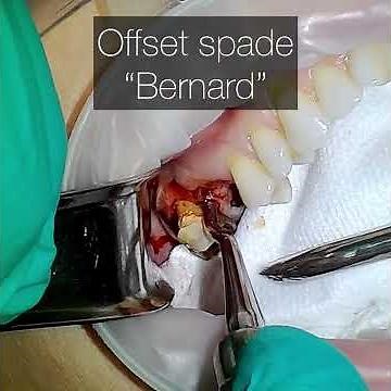 Hopeless teeth extractions with heavy calculus