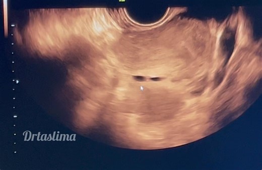 Adenomyosis and bilateral chocolate cyst | Dr Taslima Begum