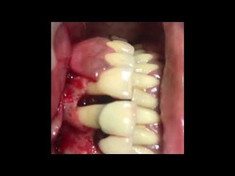 Gingival flap surgery - solution for bleeding gums and loose teeth