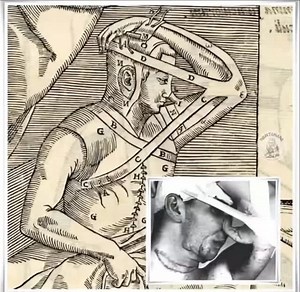 El medico italiano Gaspar Tagliacozzi (1546-1599), en el siglo XVI, desarrolló el "colgajo de antebrazo". Un método de reconstrucción nasal utilizado, con anterioridad, por la familia Branca en Sicilia. Esta técnica, conocida como método italiano o de Tagliacozzi, consistía en tomar un colgajo de piel del antebrazo y mantenerlo unido a la nariz mutilada hasta su total adhesión. Durante la intervención se hacía necesaria la presencia de un sastre, que fabricaba un arnés a medida para inmovilizar 