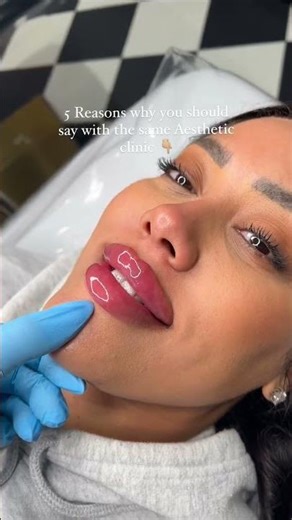 Bets Russian Lips Before After