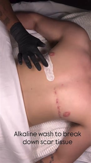 DMK Certified Estheticians are here to help you become the best version of yourself. @thelezthetician shows the start of a scar revision treatment series for this client with top surgery! Alkaline Wash swells and dissolves hypertrophic and inflamed scarring while Enzyme treatment helps rebuild healthy skin cells to replace the scars. Be your best self with DMK! #dmkskin #dmkresults #scars #scarrevision #topsurgery #oxygenation #DMK #DMKEnzyme #DMKEstheticians #DMKSkin #skinrevision #enzymemasque