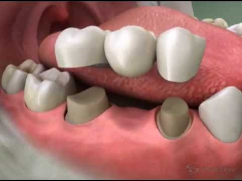 Tooth Bridge 3 Unit Bridge - Roseville Dentist