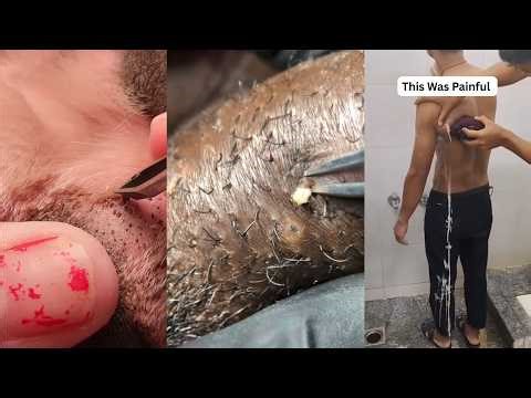 Popping huge blackheads and Pimple Popping - Best Pimple Popping Videos 298