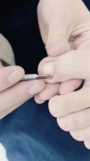 Safe and Effective Ingrown Toenail Removal by a Podiatrist