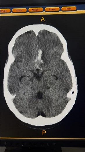 Left Frontal Intraparenchymal Hemorrhage CT Brain #shorts