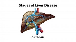 2d Animation Stages Liver Disease Stock Footage Video (100% Royalty-free) 1099337925 | Shutterstock