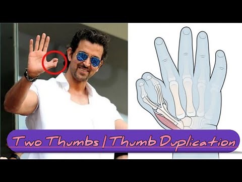 Two Thumbs on One Hand | Thumb Duplication | Split Thumb | Bifid Thumb #facts @facts.fictions