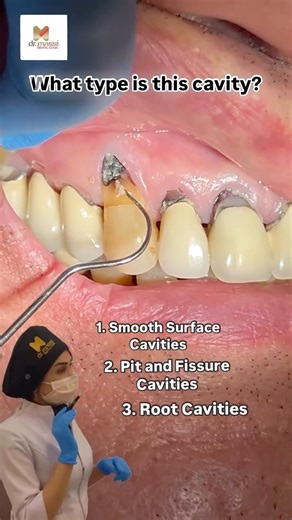 ROOT CAVITIES 😬🦷