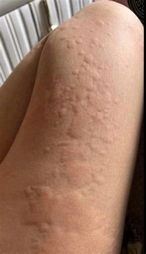 9.9K views | His whole body was itchy, he thought it was an allergy and was diagnosed...See more | Life in Motion | Facebook