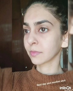 50K views · 16 shares |  Under Eye Fillers and Mono Thread Lift ...