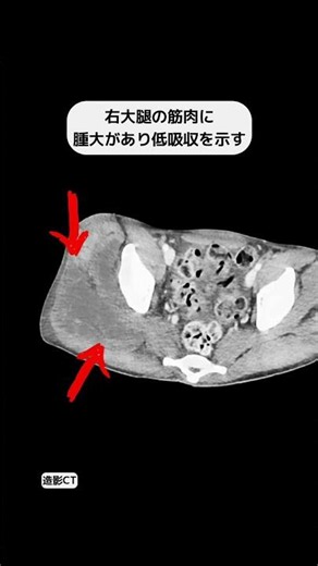 横紋筋融解症 #radiology #画像診断#shorts