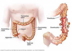 Nuevo Que Es Diverticulosis De Colon Sigmoides - Estudiar