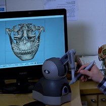 Vidéo: Traitement des déformations faciales à l’aide de la planification 3D et de l’impression d’implants spécifiques au patient