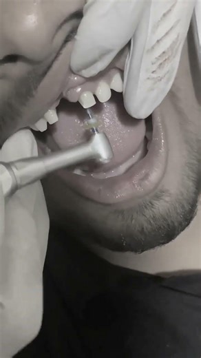 Endomotor #umairazeem #dentist #dental #rct #satisfying #viral #trending @Umairazeem8553