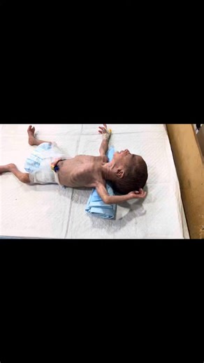 10K views · 190 reactions | Premature Baby with NG Tube Feeding |...