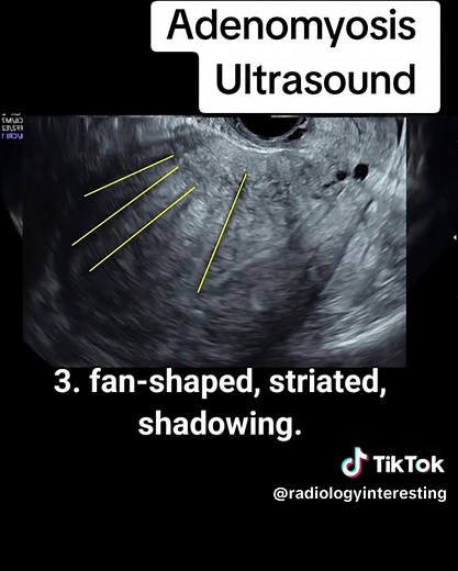 ‏Uterine Adenomyosis on ultrasound #radiology #ultrasound #radiologist