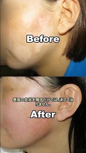 尋常性白斑の治し方｜実際の治療プロセスを公開