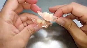 Qué son las prótesis flexibles sin ganchos -Seprolab dental