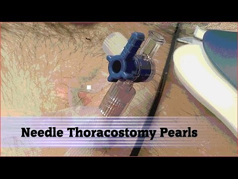 Needle Thoracostomy Pearls