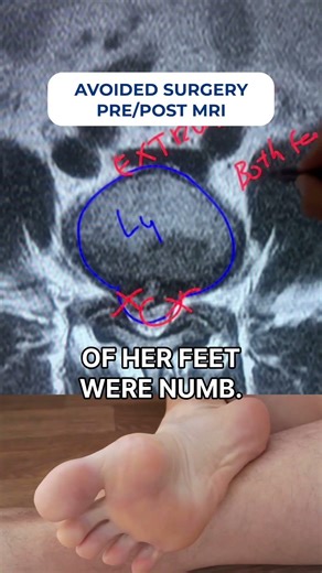 How spinal MRI revealed disc extrusion & nerve compression—no surgery needed #SpinalHealth