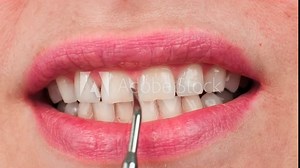 Close-up of teeth cleaning and calculus removal using an electric tool. Professional dental care