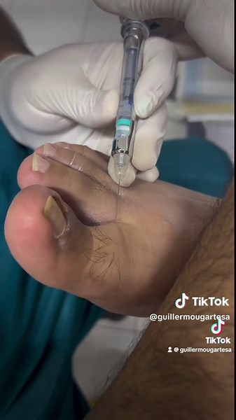 Anesthesia Procedure on Foot: Close-Up Insights