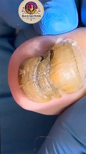 Wellness Secrets for People with Curved Nails to Prevent Calluses and Cracks 🌹🪷 #FootWellnessUSA #NailCareTips #HealthyHabits | Basiquinha