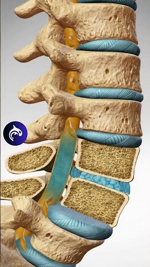 See how Spondylolisthesis affects the Spine in 3D Animation