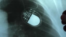 Doctor Examining X-Ray Image of Chest with Artificial Cardiac...