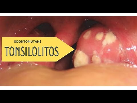 LOS TONSILOLITOS (CÁLCULOS AMIGDALINOS).