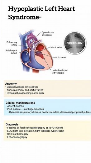Hypoplastic Left Heart Syndrome || #mbbs #nursing #study #motivation #education #medical #neet #bpt
