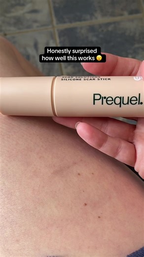 The scar stick is so under hyped! #scarstick #acnescars #surgicalscars #prequelscarsolutionstick