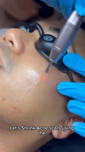 Michael Paragas, MD | "the UltraPulse Laser" Acne Scar Treatment combining UltraPulse + UltraPixel Fractional mode. -powerful, advanced ablative laser used... | Instagram