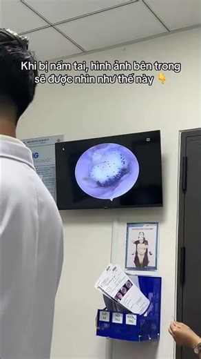 Bạn đã bao giờ nhìn thấy hình ảnh tai bị nấm bên trong như thế này chưa??? #trending #tintuc