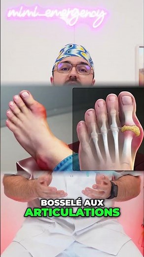 Comprendre les Tophus Risques et Complications Cachées