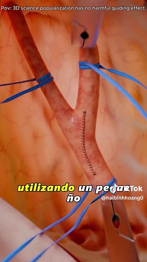 Understanding Carotid Endarterectomy Surgery with 3D Animation