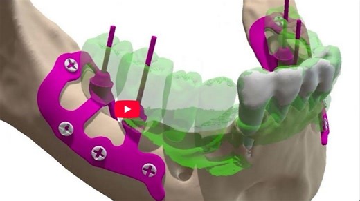 Subperiosteal Implants for the Treatment of the Posterior Mandible 下颌骨膜上种植体的外科治疗