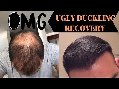 3 Tips To Deal With The Hair Transplant Ugly Duckling Phase