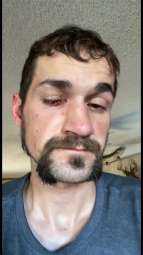 Bow Camp on Instagram: "Throwback to the eyeball punctured by a deer antler. #Bowcamp #huntingseason #huntingfails #outdoors"