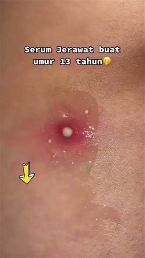 Happiness is pimples