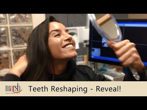 Teeth Reshaping & Contouring | Smile Reveal | Dr. Steve Marsh Cleveland Dentist