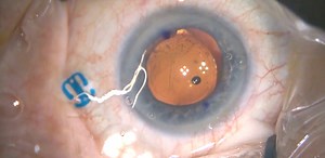 Decentered/Rotated Toric IOL - Eyetube