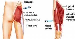 Proper Injection Techniques - Part 1