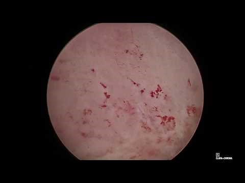 NovaSure Procedure in an Outpatient Setting utilising the fundal block anaesthetic technique